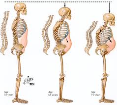 osteoporoza zdravljenje